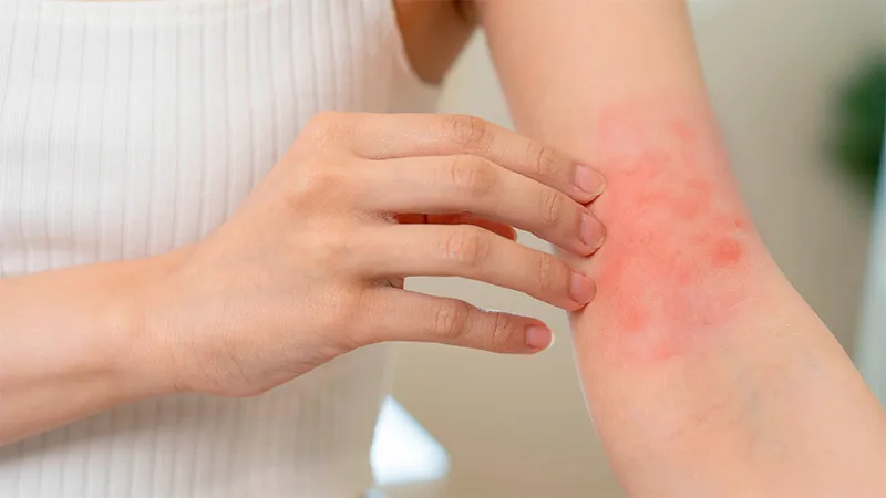 leucemia