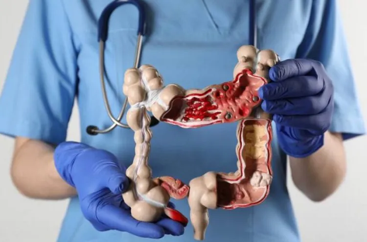 cáncer de colon 1