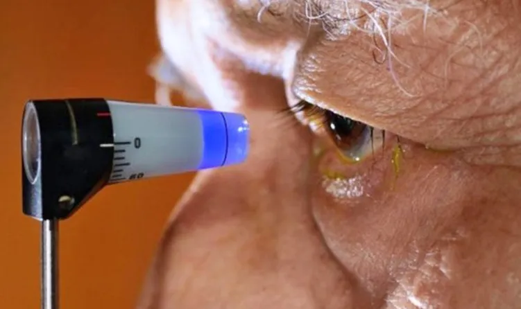 oculista, ojo, glaucoma