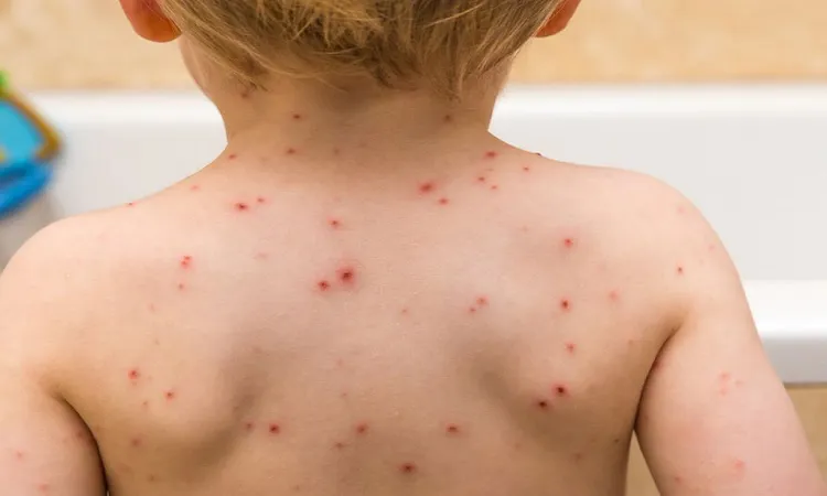 Sarampión - Entre Ríos - Diario El Enfoque