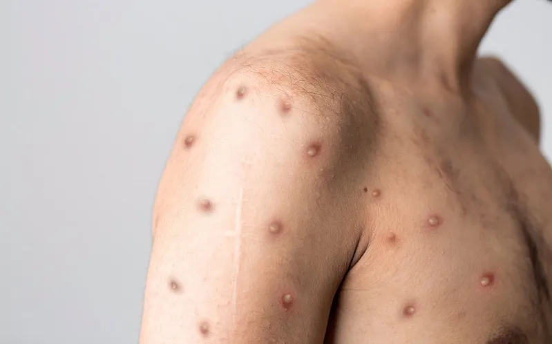 mpox